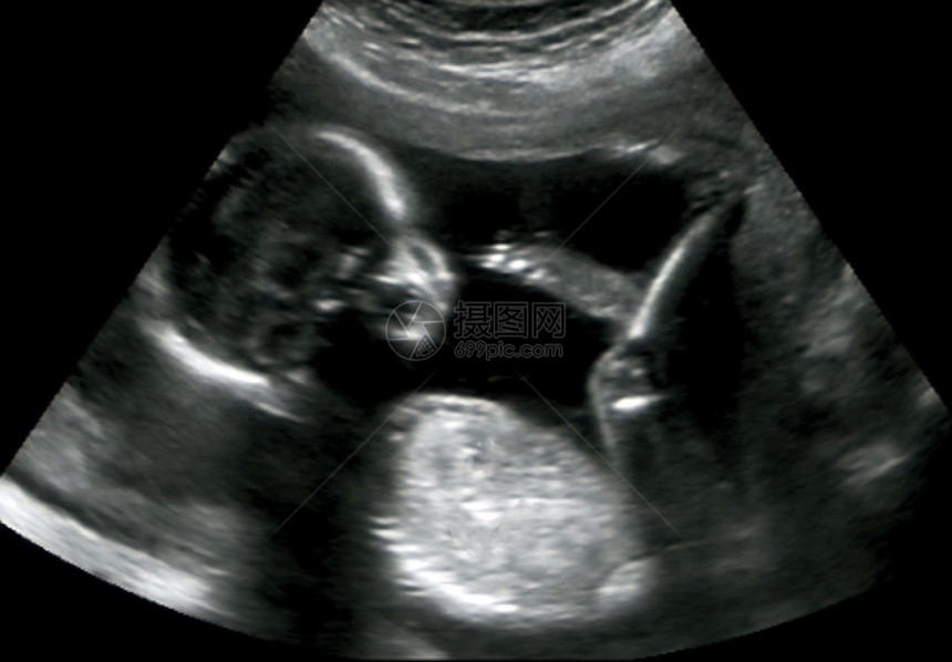第四个月胎儿的产科超声图片