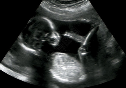 第四个月胎儿的产科超声图片
