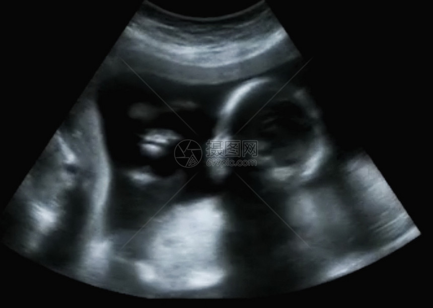 第四个月胎儿四月的超声波地理学图片