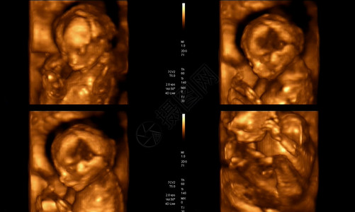 孕妇怀孕期间4D超声波的医学图像拼贴图显示背景图片