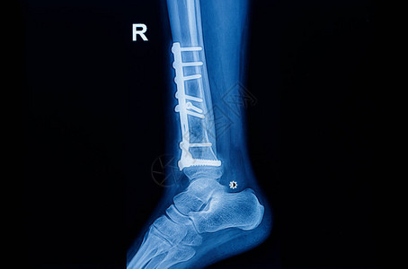 踝关节腓骨折图片