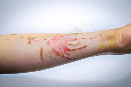 皮肤严重烧伤的人手臂图片