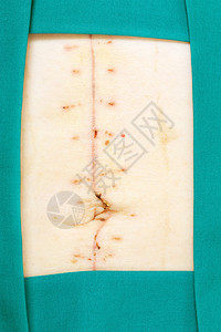 外科手术后腹部上的疤图片