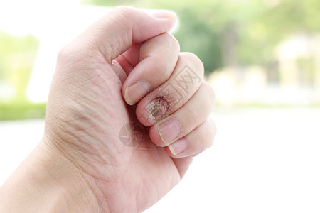 抗真菌剂白蚁指甲感染和人体损伤手指与背景