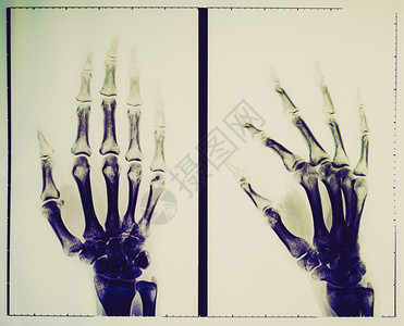用于对骨骸进行诊断放射分析的手指X射线成像图片