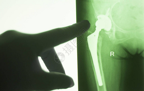 对患有关节炎和关节疼痛的老年人进行注射式X射线检查的结果图片