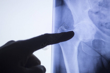 患有关节炎和关节疼痛的老年人的Hip联合X光图片