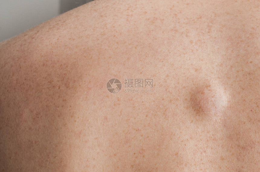 白种人背部的小脂肪瘤图片