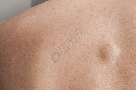 白种人背部的小脂肪瘤背景