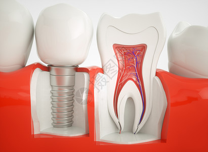 人工制品健康的牙齿和植入器设计图片