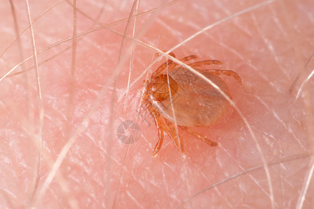 蜱喝血咬人皮肤背景图片