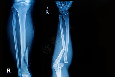 X射线图像显示腿骨和前臂骨图片