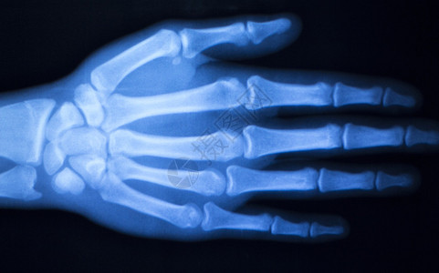 手指和大拇指医院X射线扫描结果图片