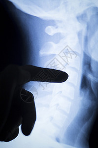成人脊柱椎骨颈部和背部医学X射线测试扫描结果显示偏和的骨科图片