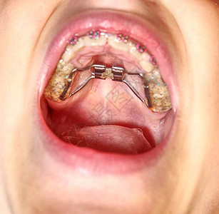 Palatal扩展长牙上的病人儿童初图片