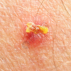 人类皮肤上有咬痕刺痛或疼痛症状接图片