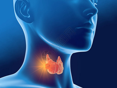 3D医疗图解显示一名妇女甲状腺癌图片
