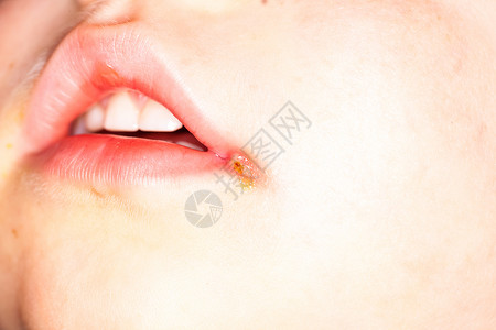 孩子的嘴唇疼痛疱疹背景图片