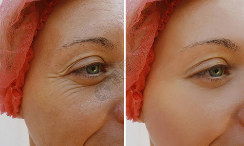 在化妆品抗老化手术前后妇图片