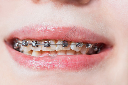 在整形治疗之前牙套在上下巴图片