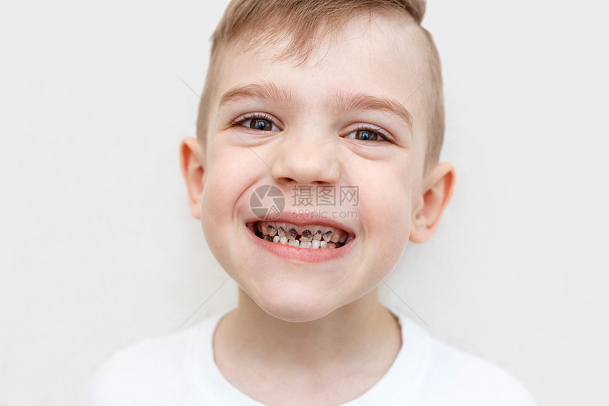 一个有龋齿的男婴牙齿的特写镜头医疗保健牙齿卫生和童年概图片