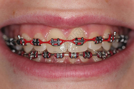 牙套和红括号的嘴部近距离图像正在背景图片