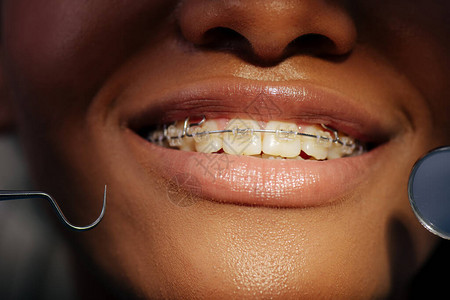 牙科器械附近戴牙套的快乐非洲裔美图片