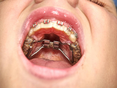 牙齿矫形牙科主题方法牙齿校正Hyrax和包皮扩张图片