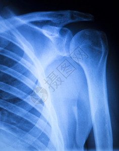 肩部损伤矫形X射线扫描心图片