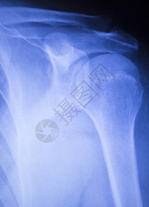 肩部联合受伤X射线创伤学和整形检查用于诊断病人运动伤害的医疗扫描图片