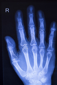 用于诊断运动受伤的手拇指手腕和手指X射线外伤图片