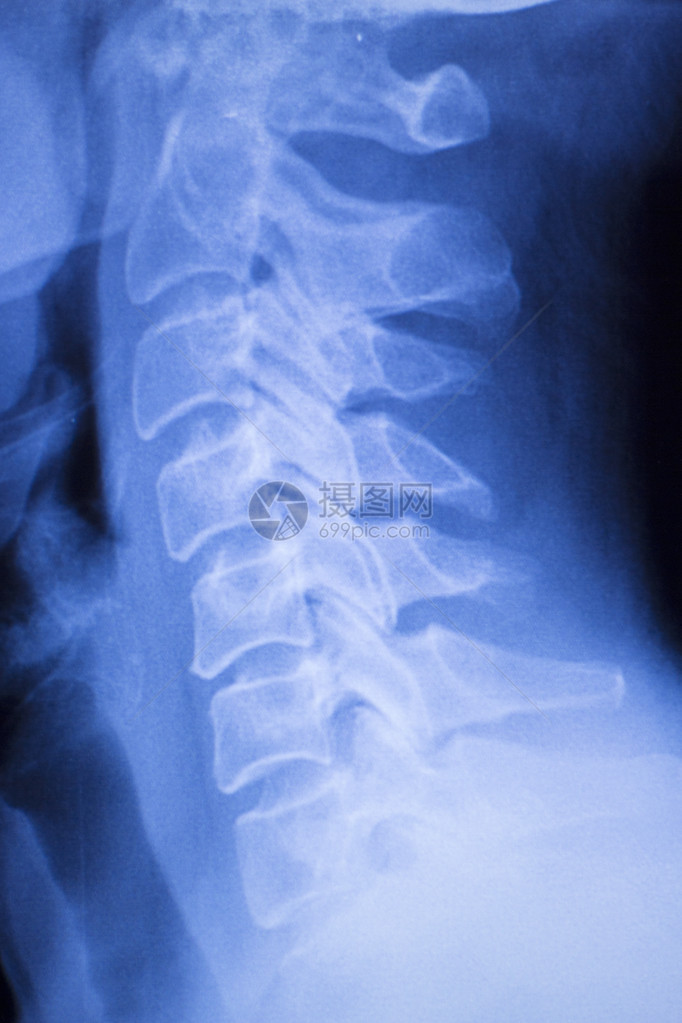 用于诊断运动受伤和关节炎症状的颈部和脊椎X射线创伤学和整形脊椎膜图片