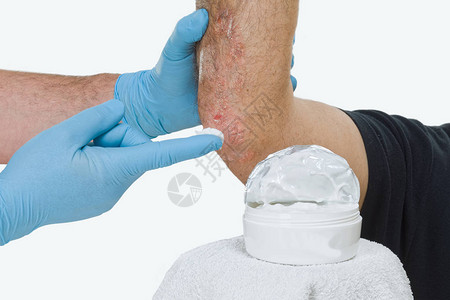 皮丝虫病是皮肤慢发炎疾病图片