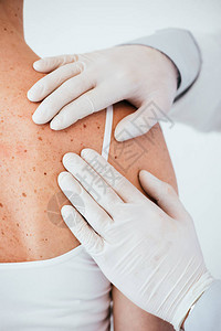 乳胶手套检查身背白与隔绝的黑皮瘤妇女时皮肤病学图片