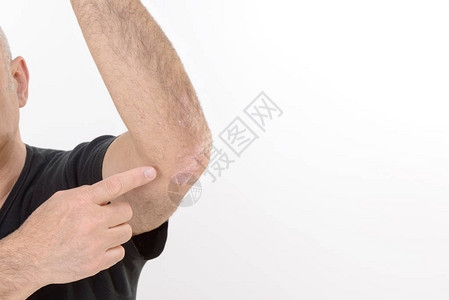 皮丝虫病是皮肤慢发炎疾病手肘的详情图片