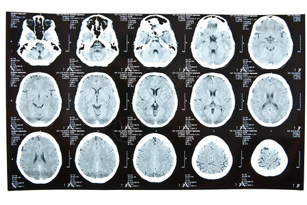 人脑断层扫描x射线图像图片