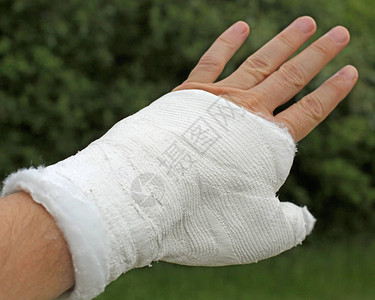 拇指骨折后用白色医用石膏固定的受伤手图片