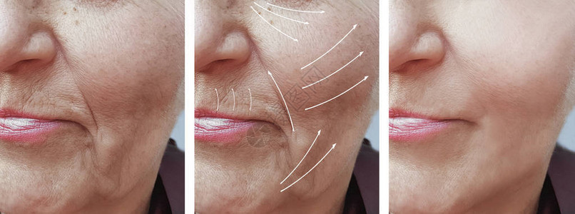 脸部老年妇女皱纹手术前后图片