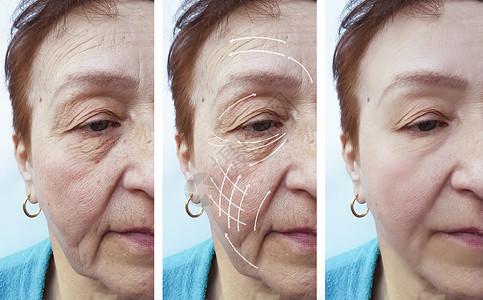 手术前和手术后箭头的整改中年长妇背景图片