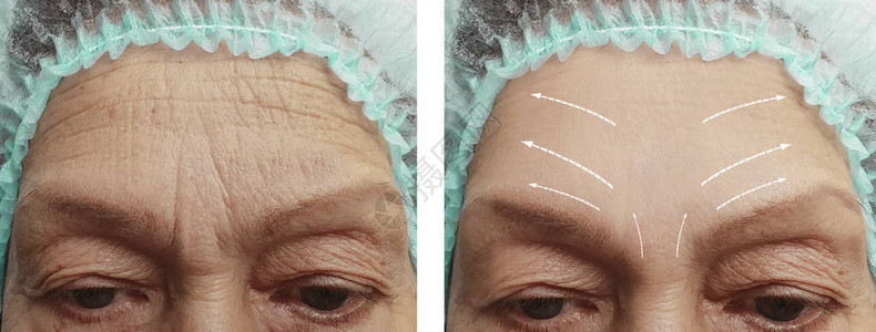 在手术前后用箭指着脸部皱纹的年图片
