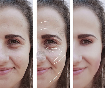 女人脸上的皱纹手术前图片