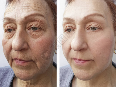 手术前后老妇人脸上的皱纹图片