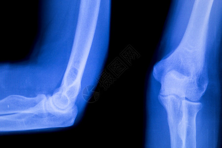 前臂手臂和肘部受伤X射线扫描试验的抽筋图片