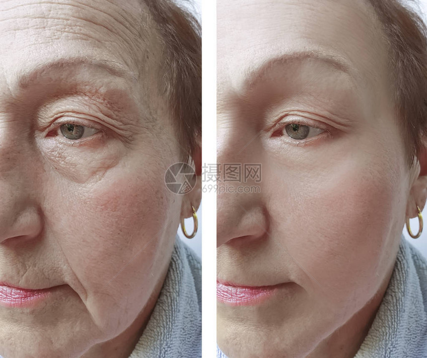 老年妇女手术前后面部皱纹图片