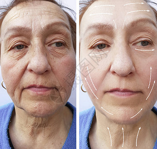 老妇人在手术前后的皱纹图片