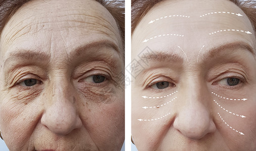 老妇人在手术前后皱纹面部图片