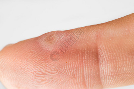 冷冻治疗后手指上的疣和水泡特写背景图片
