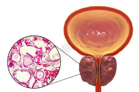 显微照片显示腺体扩张图片