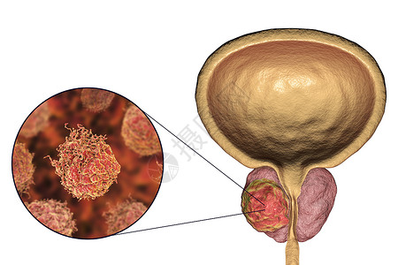 前列腺癌3D图例显示前列腺内的肿瘤和癌背景图片