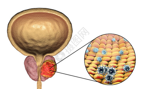 病因学前列腺癌原学的概念图3D插图显示感染前列腺并发设计图片